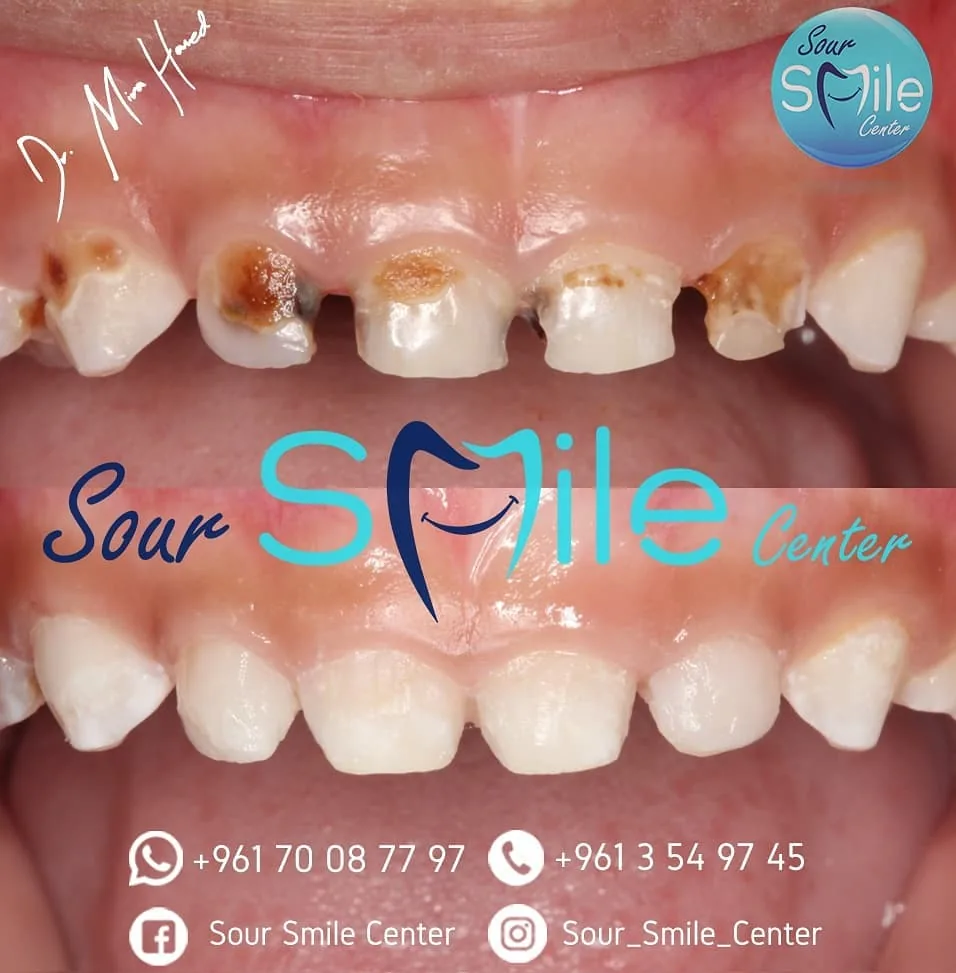 Before and after: pediatric cavities treatment
