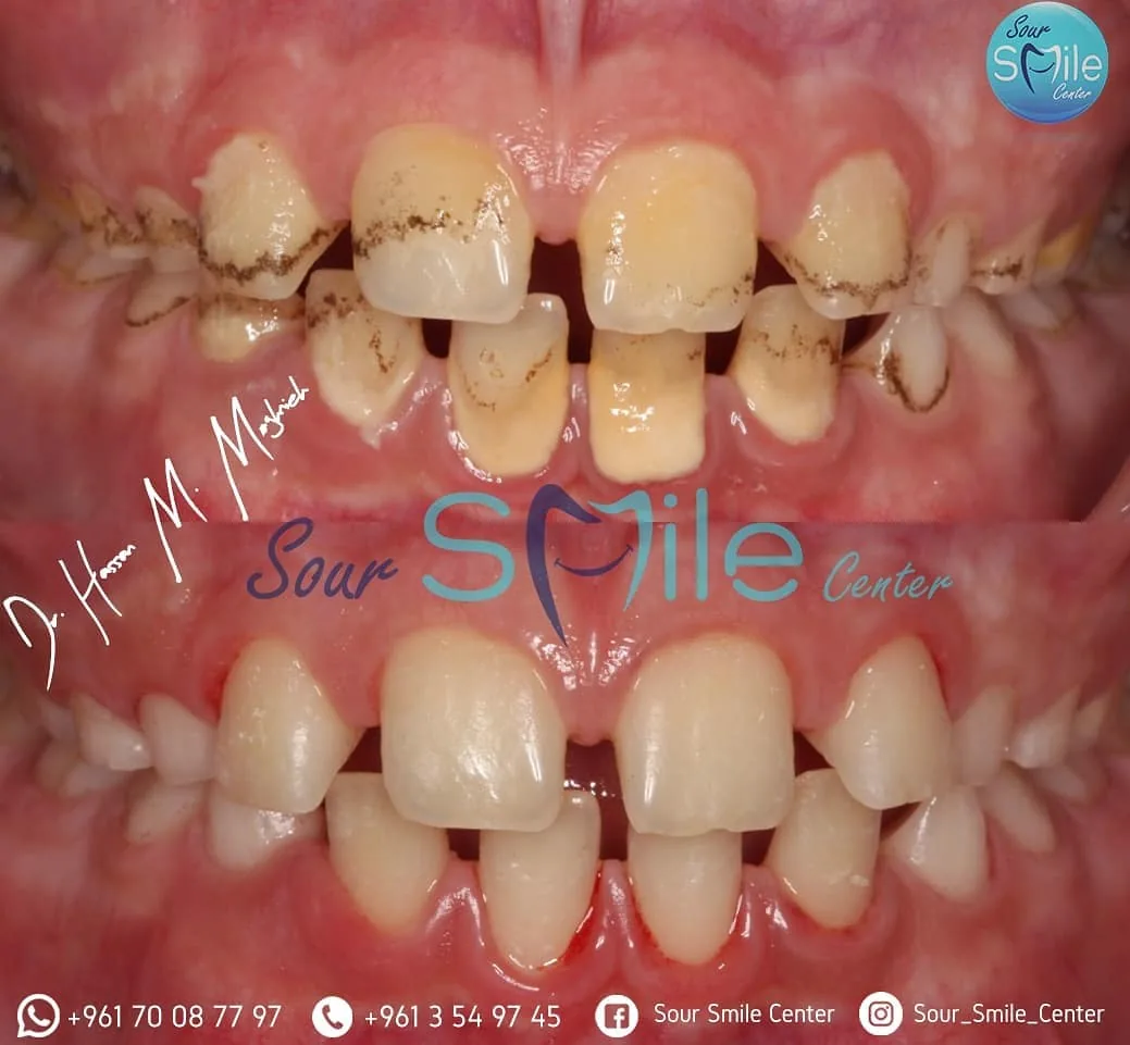 Before and after: pediatric cleaning