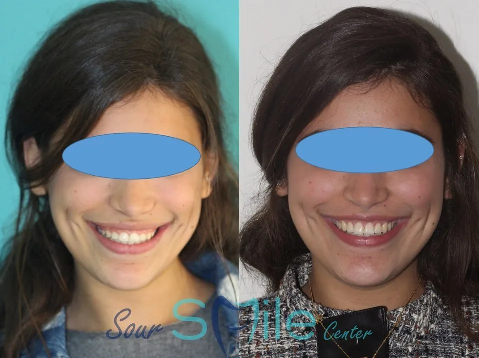 Before and after: smile makeover