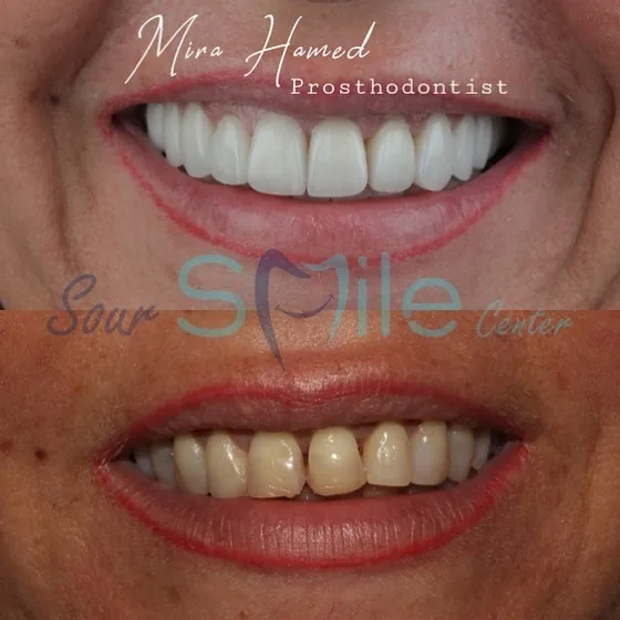 Before and after: smile restoration